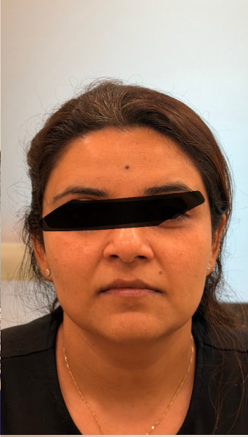 After Skin Lifting