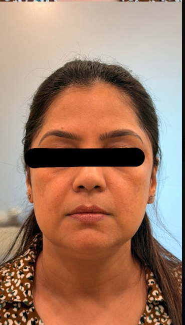 After Acne Scar Treatment