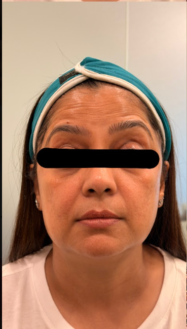 Before Acne Scar Treatment